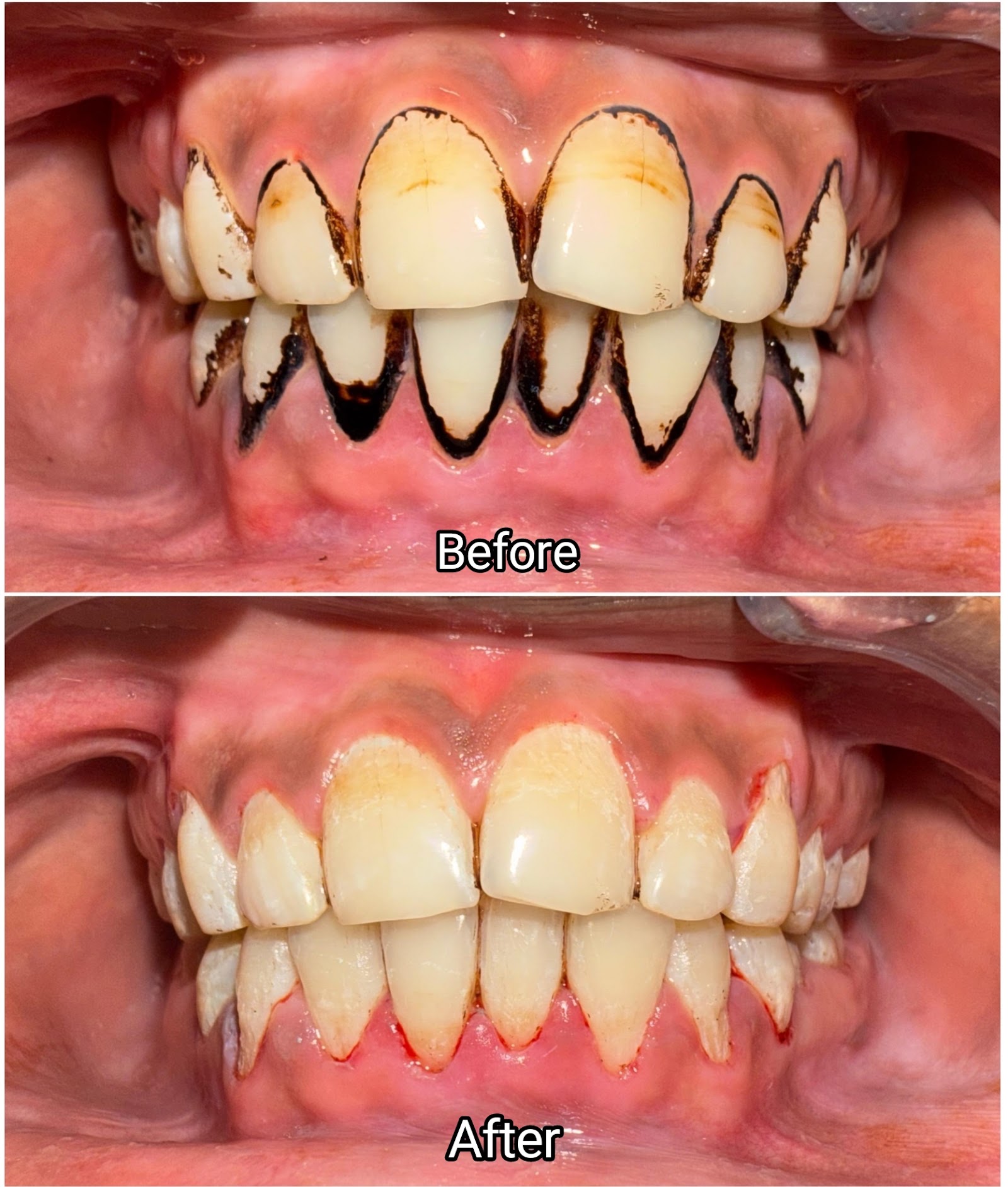 Scaling & Deep Cleaning — before and after at Siri Dental Clinic Bidadi