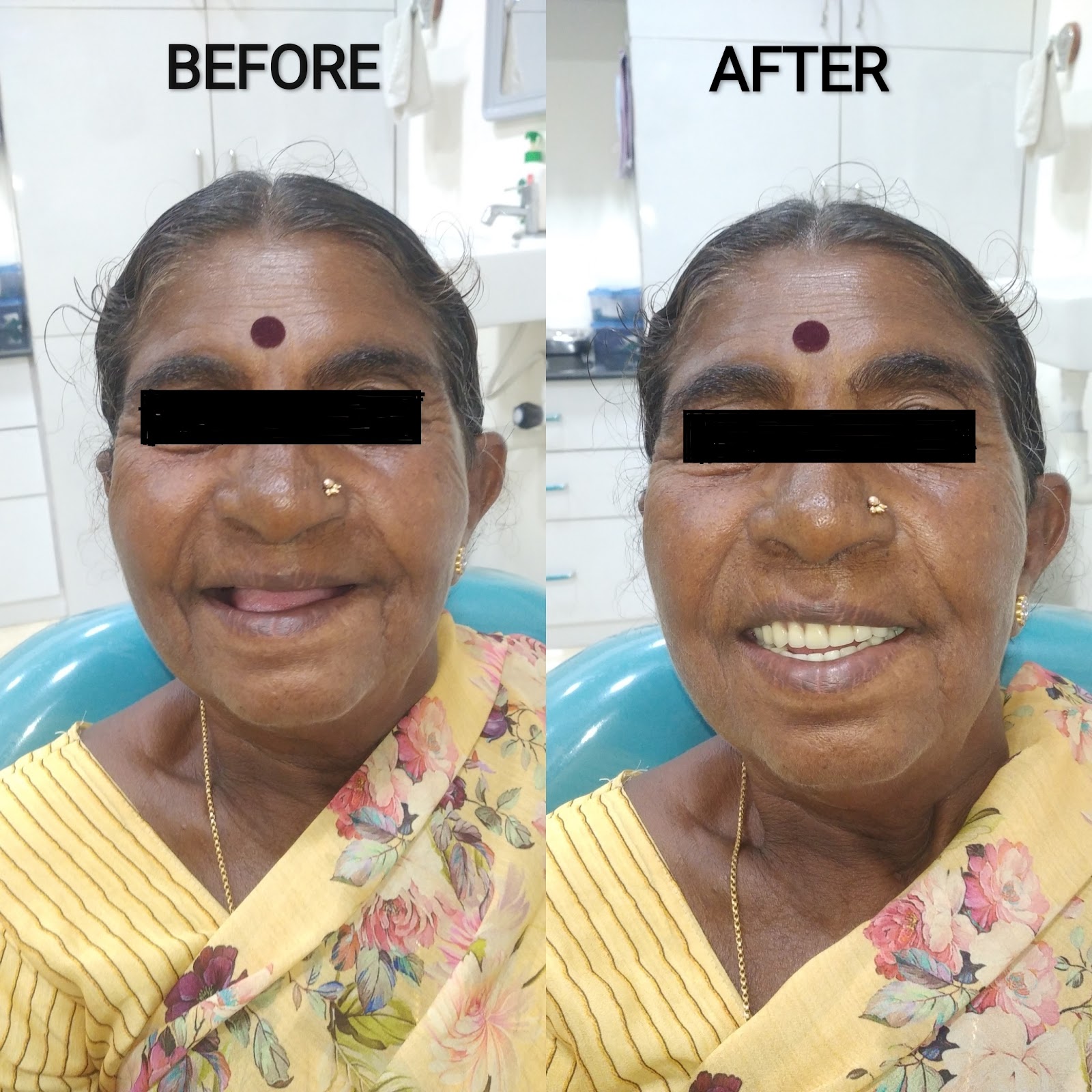 Complete Denture Rehabilitation — before and after at Siri Dental Clinic Bidadi