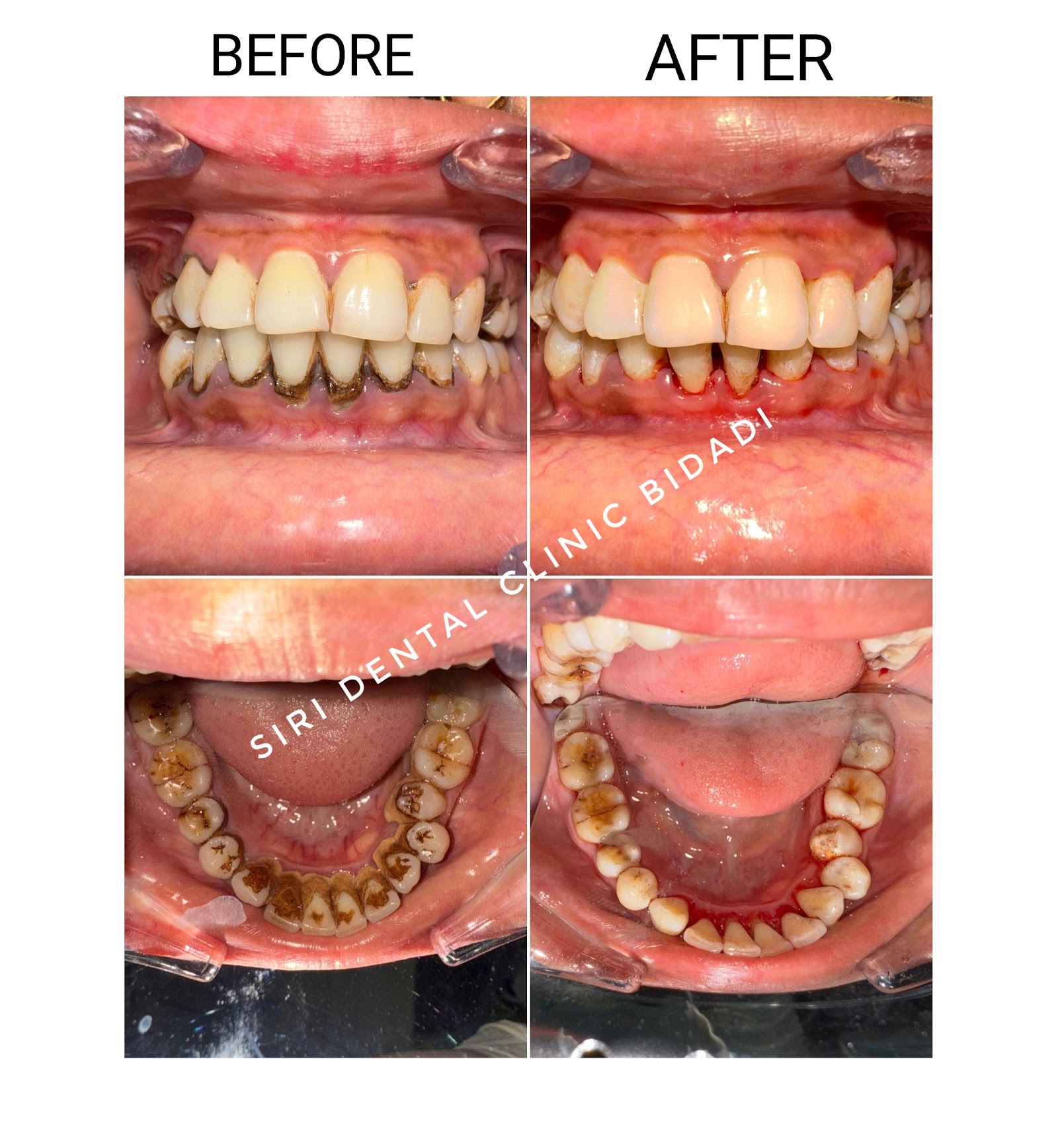 Full Mouth Cleaning — before and after at Siri Dental Clinic Bidadi